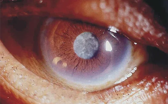 Fotografia oftalmológica macro de um olho humano com catarata avançada, evidenciando o cristalino opaco e esbranquiçado no centro da pupila. Imagem ilustrativa para a seção de exames pré-operatórios como tonometria e acuidade visual.