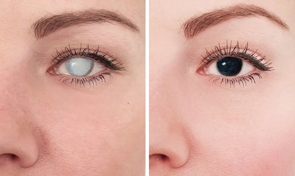 Montagem mostrando o antes e depois de um procedimento de ceratopigmentação. À esquerda, um olho com opacidade corneana (leucoma) e, à direita, o resultado com a reconstrução estética da cor da córnea.