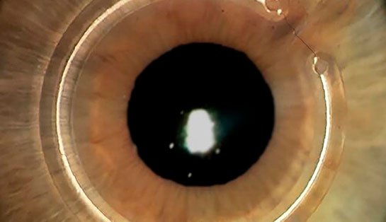 Fotografia médica em close de um olho humano com implante de anel estromal semicircular de PMMA inserido na córnea para correção de ceratocone.